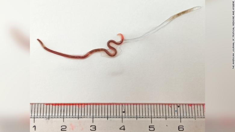 Not always a good idea to eat raw fish, Sushi gives woman live worm in her tonsils